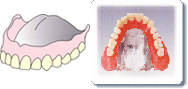 総義歯（金属床）